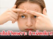 อันตรายมาก! สาววัย 15 ปี เสียชีวิตเพราะ สิวเม็ดเดียว หมอเตือนนิสัยที่หลายคนยังทำ