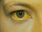 ควรระวัง!!! ร่างกายมีอาการคัน 2 ส่วนนี้ อาจเป็นสัญญาณของ “มะเร็งตับ” ไม่ใช่อาการแพ้