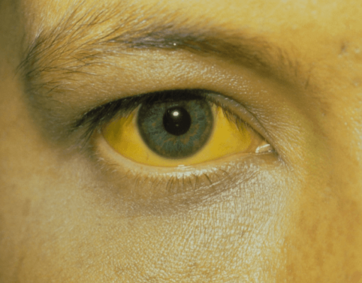 ควรระวัง!!! ร่างกายมีอาการคัน 2 ส่วนนี้ อาจเป็นสัญญาณของ “มะเร็งตับ” ไม่ใช่อาการแพ้