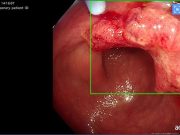 หนุ่มวัย 28 ไม่มีอาการป่วย ช็อกตรวจเจอมะเร็ง หมอเตือน 1 สิ่งสำคัญที่ทุกคน “ต้องทำ”