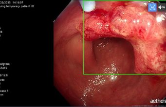 หนุ่มวัย 28 ไม่มีอาการป่วย ช็อกตรวจเจอมะเร็ง หมอเตือน 1 สิ่งสำคัญที่ทุกคน “ต้องทำ”