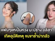 แฟนๆแห่เป็นห่วง นางเอกดัง เกิดอุบัติเหตุ จนขาช้ำน่ากลัว