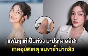 แฟนๆแห่เป็นห่วง นางเอกดัง เกิดอุบัติเหตุ จนขาช้ำน่ากลัว