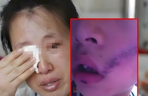 ลูกชายร้องลั่น เย็บหน้า 38 เข็ม แค่เพราะหยิบ “สิ่งนี้” จากช่องฟรีซ เตือนแช่ไว้แทบทุกบ้าน!!!