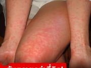 “ไข้รากสาดน้อย” กับ “ไข้รากสาดใหญ่” ต่างกันอย่างไร? แบบไหนอันตรายกว่า?