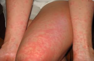 “ไข้รากสาดน้อย” กับ “ไข้รากสาดใหญ่” ต่างกันอย่างไร? แบบไหนอันตรายกว่า?