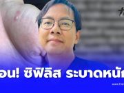 หมอเตือน “ซิฟิลิสระบาดหนัก” แล้ว ใครมีอาการดังนี้ ไปหาหมอด่วน