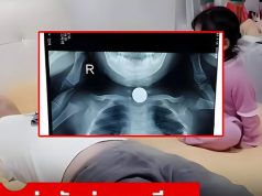 ลูกสาว 3 ขวบ เล่นกับพ่อบนเตียง จู่ๆ อาเจียนดับสลด หมอตรวจศพถึงรู้ “กิน” อะไรเข้าไป