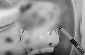 ช็อก! หนุ่มไต้หวันพบแก้วเซรามิกติดค้างในทวารหนัก อ้าง ‘เกิดขึ้นโดยอุบัติเหตุ’