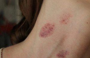 อวสานความฟิน แฟนหนุ่ม “จูบส่วนนี้” สาวอัมพาตเข้าห้องฉุกเฉิน หมอปวดหัว ทำกันแทบทุกคู่!