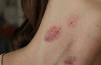 อวสานความฟิน แฟนหนุ่ม “จูบส่วนนี้” สาวอัมพาตเข้าห้องฉุกเฉิน หมอปวดหัว ทำกันแทบทุกคู่!