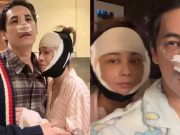 เอมี่ ศัลยกรรมย้อนวัยที่เกาหลี ซี แก้จมูกใหม่ใช้กระดูกซี่โครง เผยโฉมความสวยหล่อ