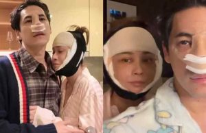 เอมี่ ศัลยกรรมย้อนวัยที่เกาหลี ซี แก้จมูกใหม่ใช้กระดูกซี่โครง เผยโฉมความสวยหล่อ