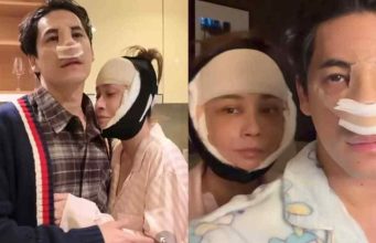 เอมี่ ศัลยกรรมย้อนวัยที่เกาหลี ซี แก้จมูกใหม่ใช้กระดูกซี่โครง เผยโฉมความสวยหล่อ