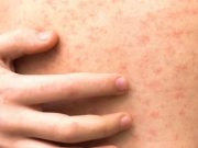 จับตา โรคหัดลาม ระบาดหนักชายแดน กลุ่มเสี่ยงต้องรีบฉีดวัคซีน ก่อนลุกลาม