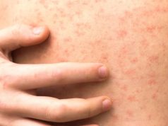 จับตา โรคหัดลาม ระบาดหนักชายแดน กลุ่มเสี่ยงต้องรีบฉีดวัคซีน ก่อนลุกลาม