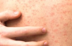 จับตา โรคหัดลาม ระบาดหนักชายแดน กลุ่มเสี่ยงต้องรีบฉีดวัคซีน ก่อนลุกลาม