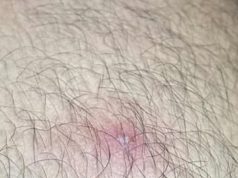 หนุ่มคิดว่าตัวเองเป็นสิว สุดท้ายกลายเป็นเรื่องสยอง ถึงขั้นผ่าตัด