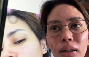 สาวเล่าอุทาหรณ์ แค่ผื่นเล็ก ๆ สุดท้ายเกือบเอาชีวิตไม่รอด