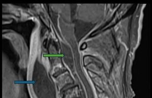 อย่าคิดว่าเรื่องเล็ก! ชาย “ฟันผุ” ไม่รักษา จนกลืนไม่ได้-น้ำลายไหล ลามผุดฝีหลังคอ สุดท้ายดับ