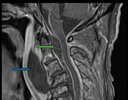 อย่าคิดว่าเรื่องเล็ก! ชาย “ฟันผุ” ไม่รักษา จนกลืนไม่ได้-น้ำลายไหล ลามผุดฝีหลังคอ สุดท้ายดับ