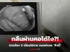 เกือบจัดงานศพ หนุ่มปวดท้องเป็นเดือนๆ ไม่หาย หมอผ่า “สิ่งนี้” ออกมา ตาตื่นทั้งครอบครัว!