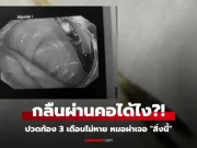 เกือบจัดงานศพ หนุ่มปวดท้องเป็นเดือนๆ ไม่หาย หมอผ่า “สิ่งนี้” ออกมา ตาตื่นทั้งครอบครัว!