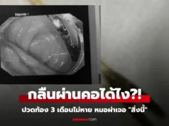 เกือบจัดงานศพ หนุ่มปวดท้องเป็นเดือนๆ ไม่หาย หมอผ่า “สิ่งนี้” ออกมา ตาตื่นทั้งครอบครัว!