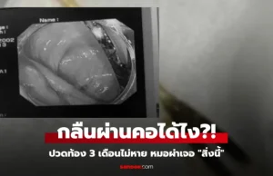 เกือบจัดงานศพ หนุ่มปวดท้องเป็นเดือนๆ ไม่หาย หมอผ่า “สิ่งนี้” ออกมา ตาตื่นทั้งครอบครัว!