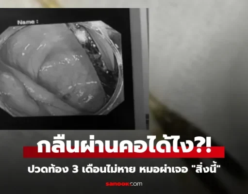 เกือบจัดงานศพ หนุ่มปวดท้องเป็นเดือนๆ ไม่หาย หมอผ่า “สิ่งนี้” ออกมา ตาตื่นทั้งครอบครัว!