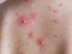 ยอดพุ่งหมื่นราย! สุกใสระบาดหนัก เด็กเล็กเสี่ยงสูง เช็กอาการด่วน