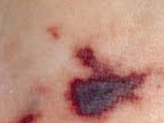 อย่าชะล่าใจ ไข้กาฬหลังแอ่นไทยพุ่งสูงสุดใน 10 ปี เด็กเล็ก-วัยรุ่นเสี่ยงสุด