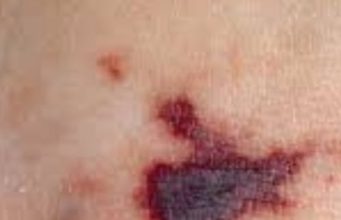 อย่าชะล่าใจ ไข้กาฬหลังแอ่นไทยพุ่งสูงสุดใน 10 ปี เด็กเล็ก-วัยรุ่นเสี่ยงสุด