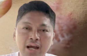 น่าห่วง “เสก โลโซ” ตุ่มใสขึ้นแขน หมอเตือนรีบรักษาภายใน 72 ชม.