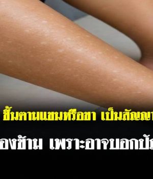 จุดขาวเล็ก ๆ ขึ้นตามแขนหรือขา เป็นสัญญาณของอะไร? อย่าเพิ่งมองข้าม เพราะอาจบอกปัญหาผิวที่ค