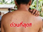 เตือน ใครมีอาการดังนี้ แล้ว “รักษาไม่หาย” ไปตรวจด่วน ระวัง HIV