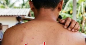 เตือน ใครมีอาการดังนี้ แล้ว “รักษาไม่หาย” ไปตรวจด่วน ระวัง HIV