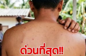 เตือน ใครมีอาการดังนี้ แล้ว “รักษาไม่หาย” ไปตรวจด่วน ระวัง HIV