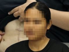 สาวผ่าตัดนิ่วในถุงน้ำดี หมอทำพลาด ชีวิตเปลี่ยนทรมานนับปี