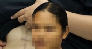 สาวผ่าตัดนิ่วในถุงน้ำดี หมอทำพลาด ชีวิตเปลี่ยนทรมานนับปี