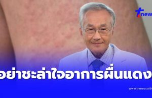 อย่าชะล่าใจ เปิดอาการผื่นแดงตามตัว ก่อนหมอตรวจเจอ ซิฟิลิสระยะ 2