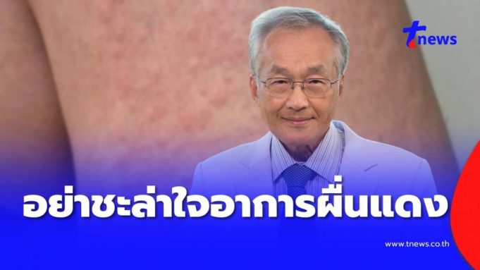 อย่าชะล่าใจ เปิดอาการผื่นแดงตามตัว ก่อนหมอตรวจเจอ ซิฟิลิสระยะ 2