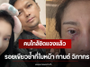 คนใกล้ชิดแจงแล้ว รอยเขียวช้ำที่ใบหน้า กานต์ วิภากร