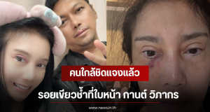 คนใกล้ชิดแจงแล้ว รอยเขียวช้ำที่ใบหน้า กานต์ วิภากร