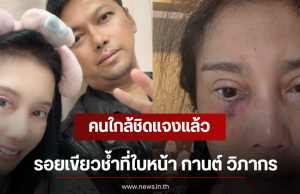 คนใกล้ชิดแจงแล้ว รอยเขียวช้ำที่ใบหน้า กานต์ วิภากร