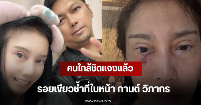 คนใกล้ชิดแจงแล้ว รอยเขียวช้ำที่ใบหน้า กานต์ วิภากร
