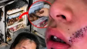 ลูกชายร้องลั่น เย็บหน้า 38 เข็ม แค่เพราะหยิบ “สิ่งนี้” จากช่องฟรีซ เตือนแช่ไว้แทบทุกบ้าน!!!